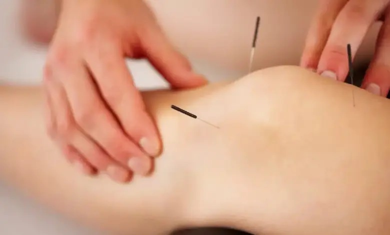 Acupuntura