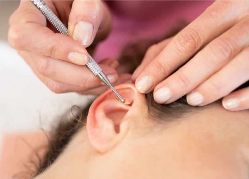 AURICULOTERAPIA